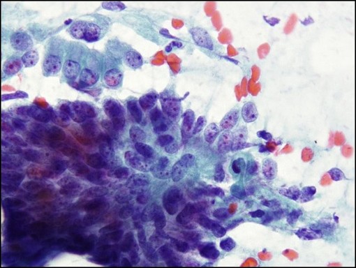 Mikroszkóp alatt rákos sejtek, Kép: Medserv+