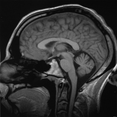 Az agy MRI-képe: wikipedia
