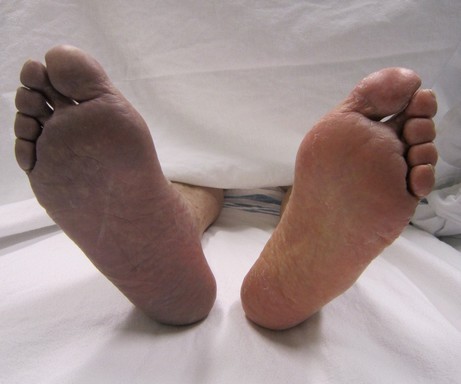Trombózisos láb, Kép: wikimedia